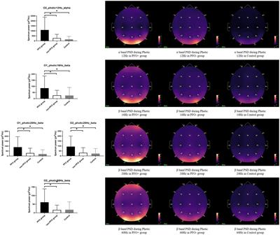 The patent foramen ovale may alter migraine brain activity: A pilot study of electroencephalography spectrum and functional connectivity analysis